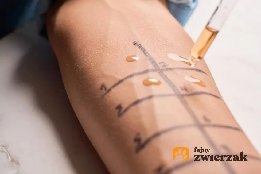 Zbliżenie ręki, na której przeprowadzane są testy alergiczne